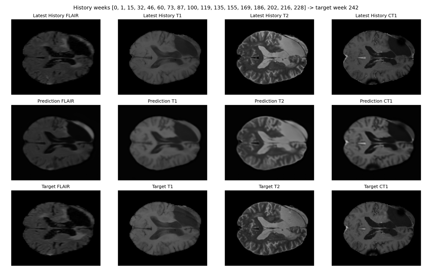 Spatiotemporal Glioblastoma Evolution Visual Prediction