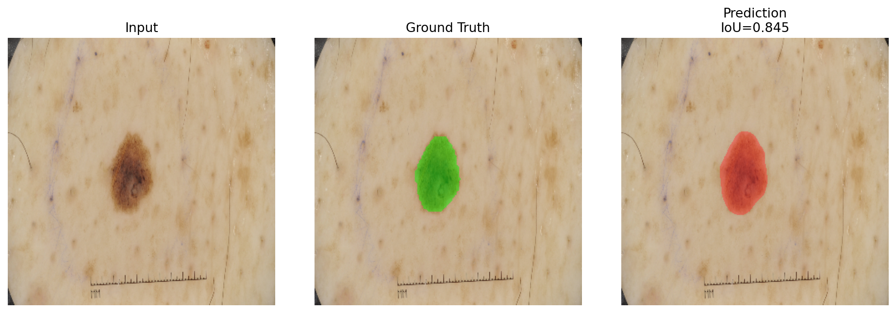 BA-DeepLabV3 qualitative lesion segmentation sample 1