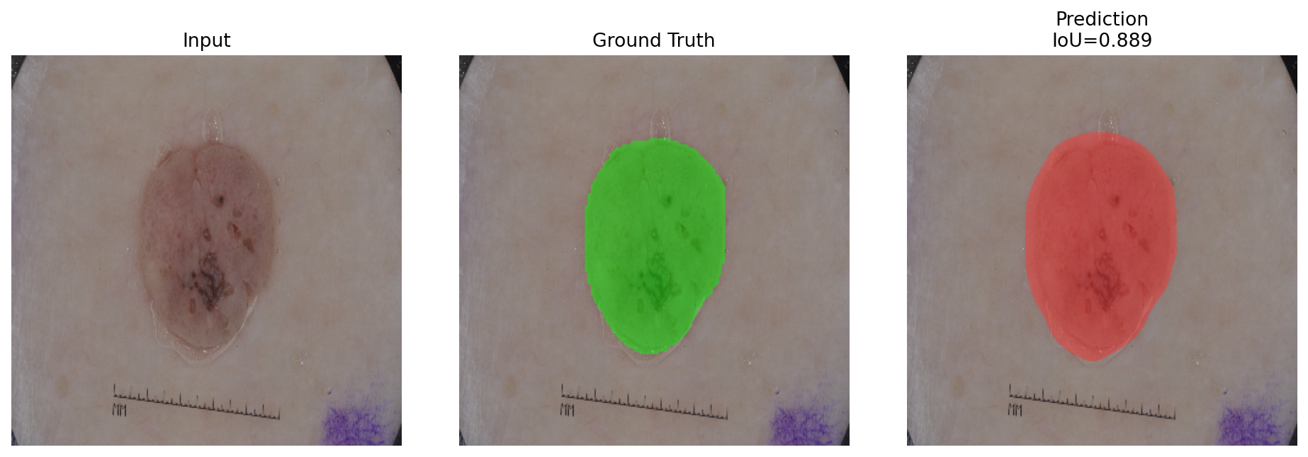 BA-DeepLabV3 qualitative lesion segmentation sample 5