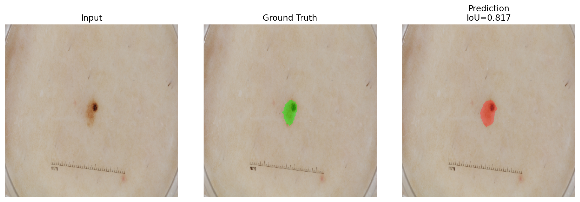 DeepLabV3 qualitative lesion segmentation sample 2