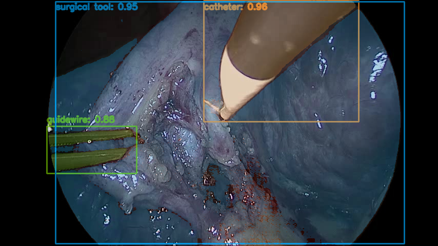 Tracked tool overlay on a middle frame of the re-grounded Endoscapes sequence